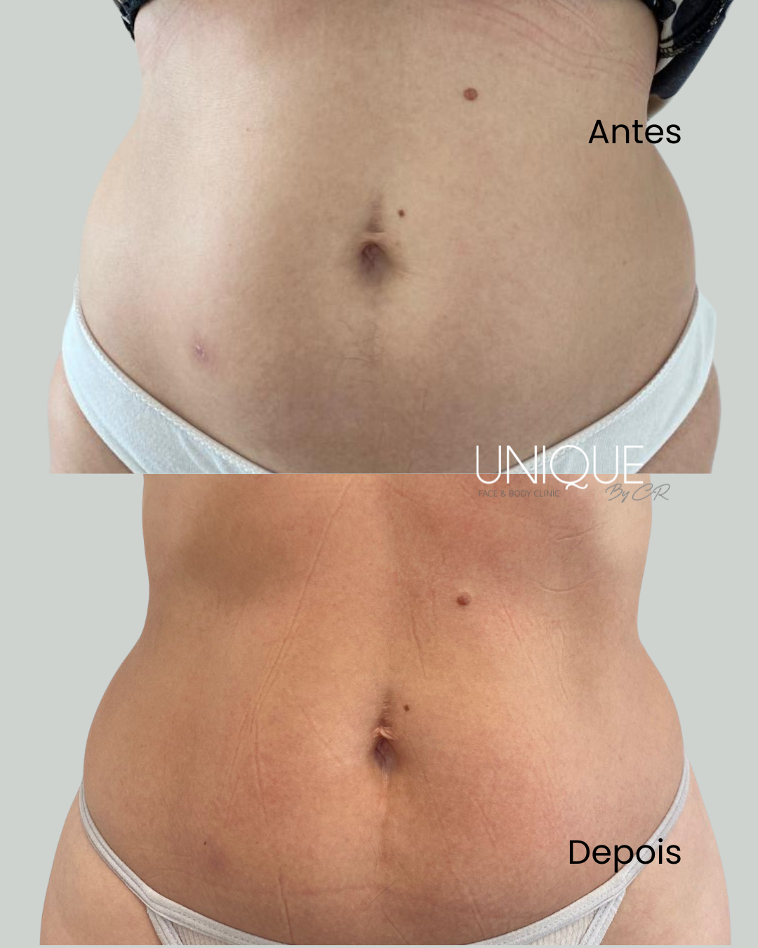 Antes e depois — tonificação abdominal (mulher)