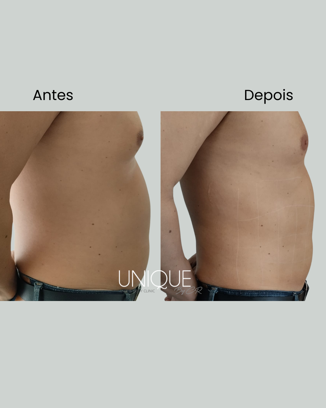 Antes e depois — redução de gordura abdominal (homem, perfil)