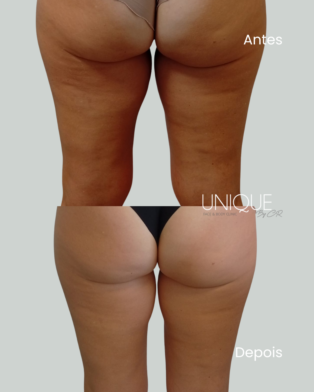 Antes e depois — redução de celulite em glúteos e pernas
