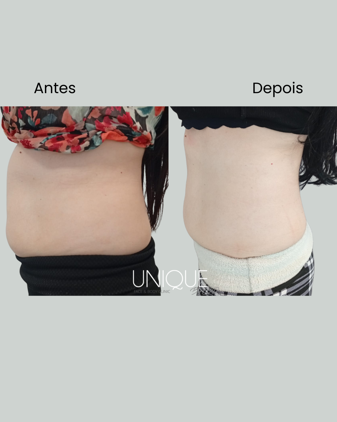 Antes e depois — redução de flancos (mulher)