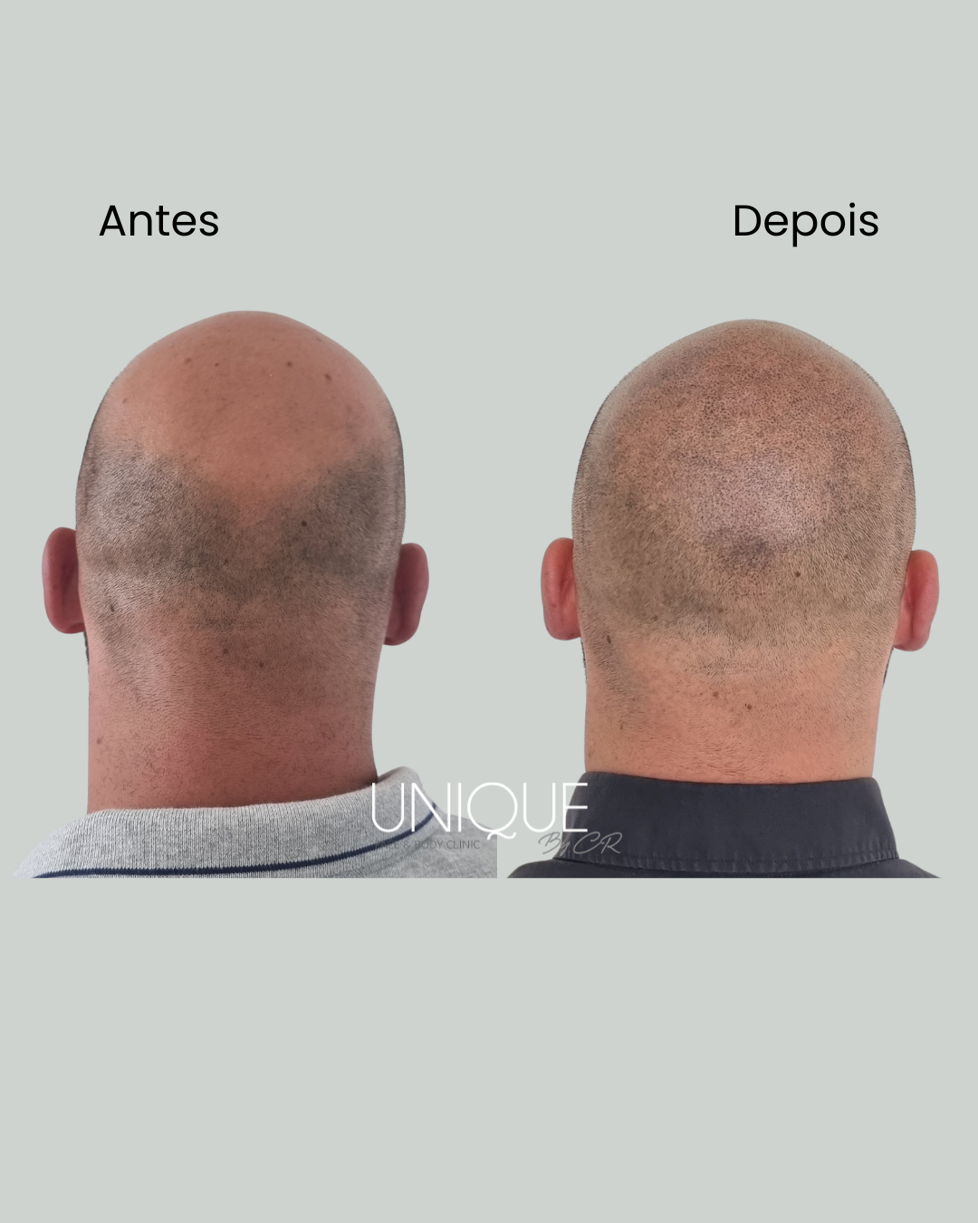 Antes e depois — densidade na coroa (vista posterior)