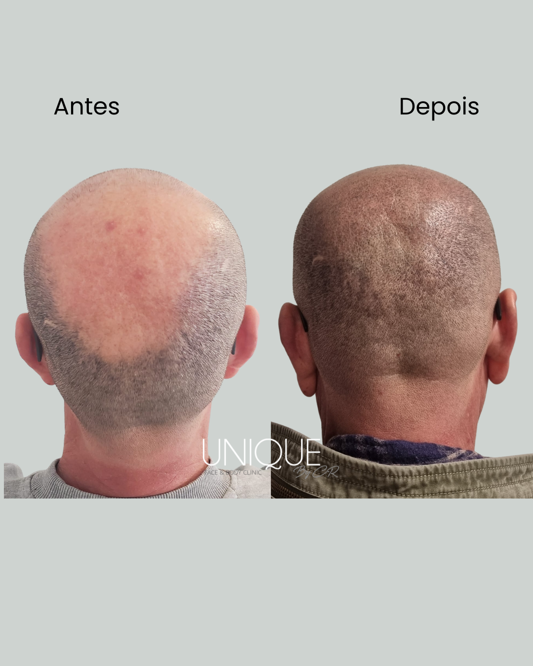 Antes e depois — uniformização da coroa com rarefação capilar