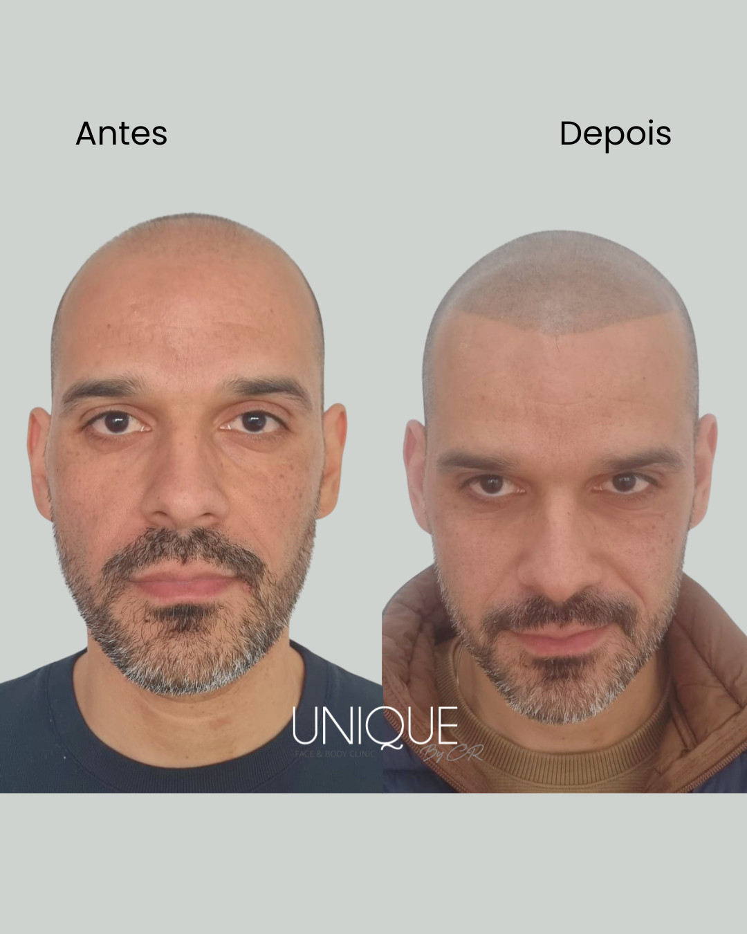 Antes e depois — definição da linha capilar com efeito cabelo rapado