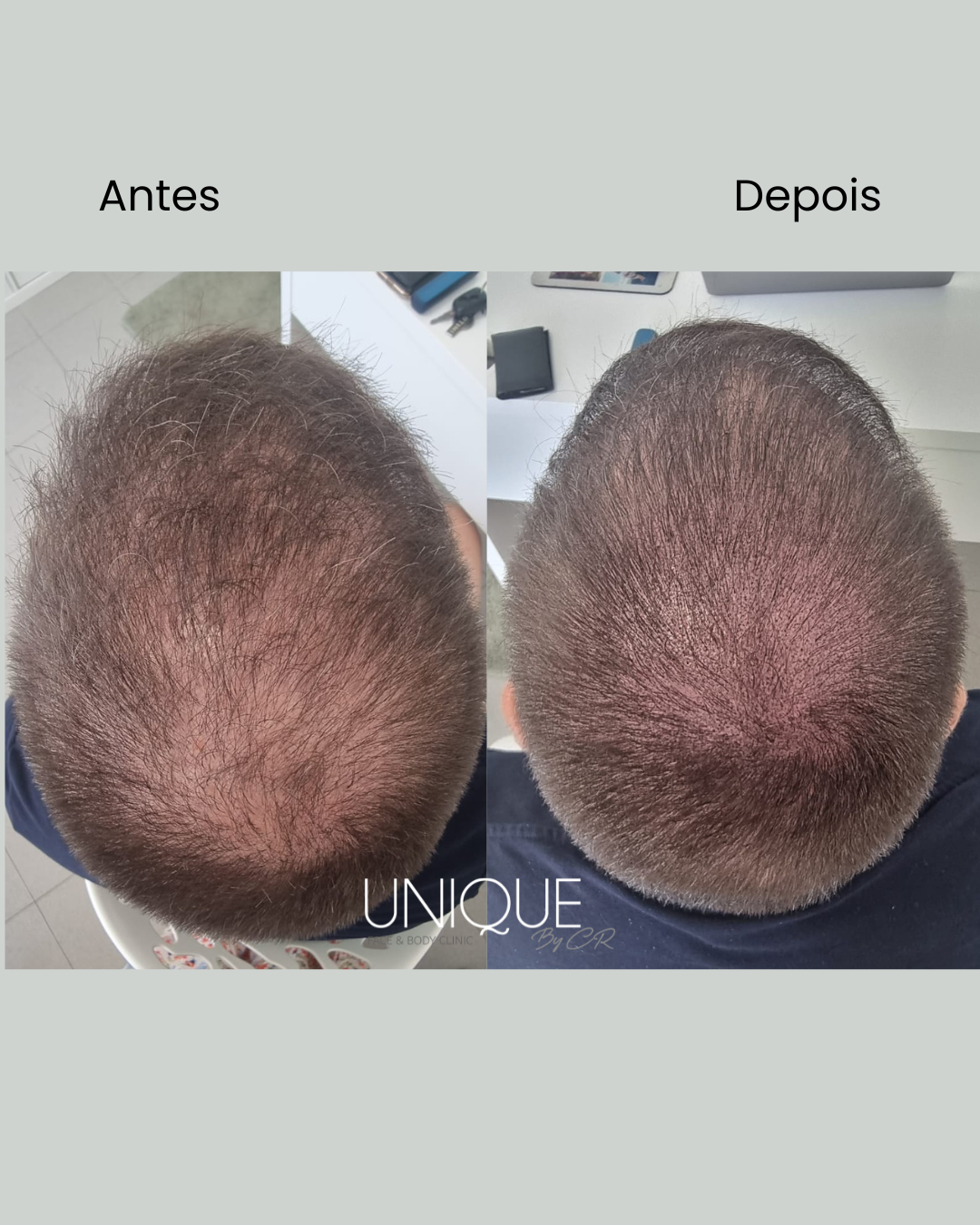 Antes e depois — densidade no topo da cabeça (rarefação capilar)