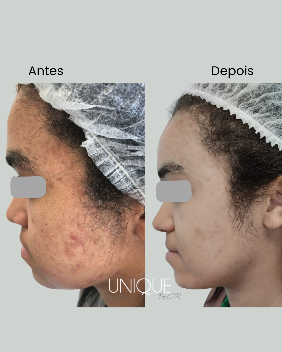 Antes e depois — tratamento de acne (perfil)