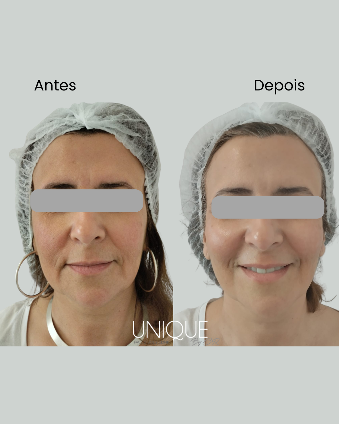 Antes e depois — melhoria da qualidade da pele (mulher, vista frontal)