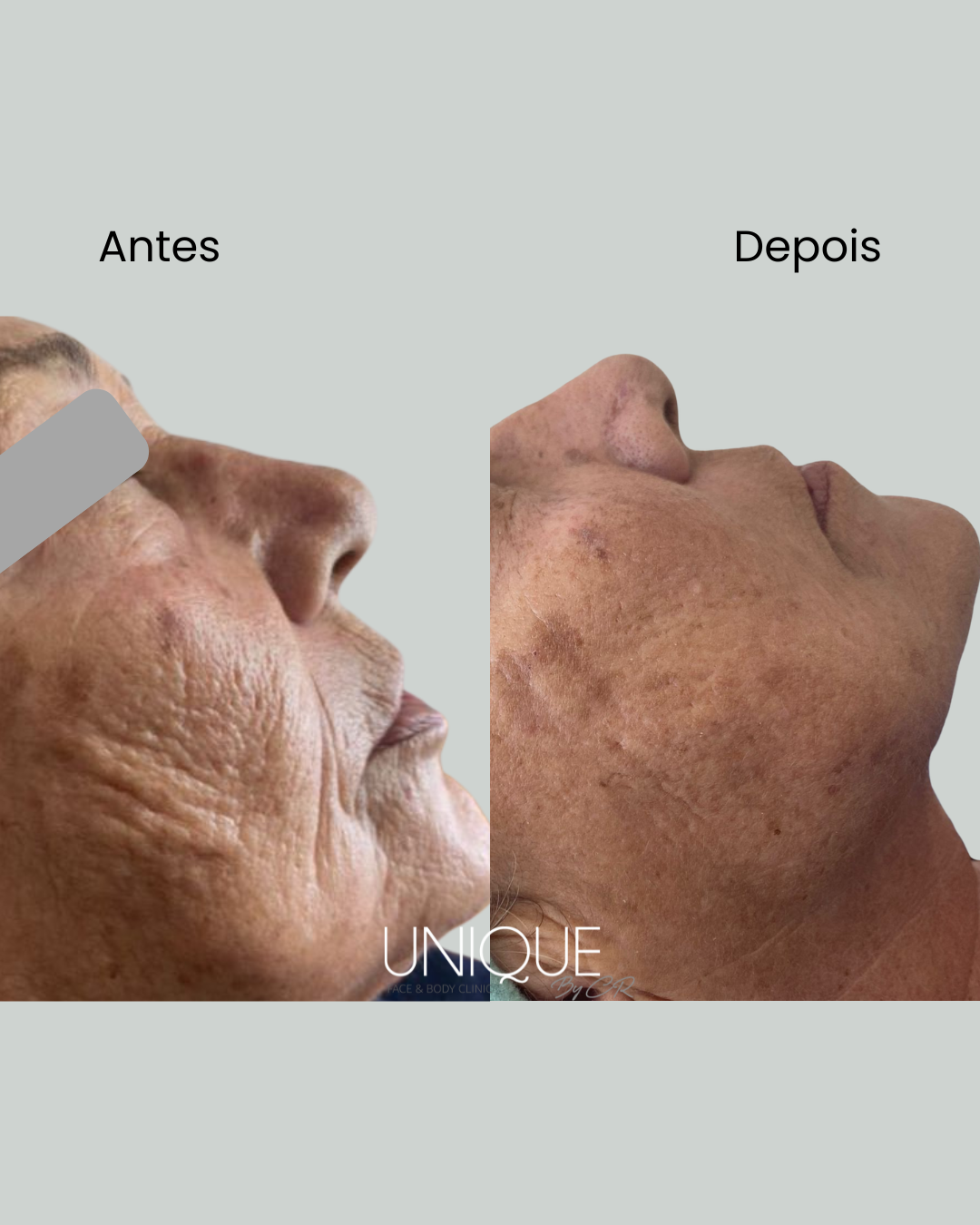 Antes e depois — textura da pele (homem, vista lateral)