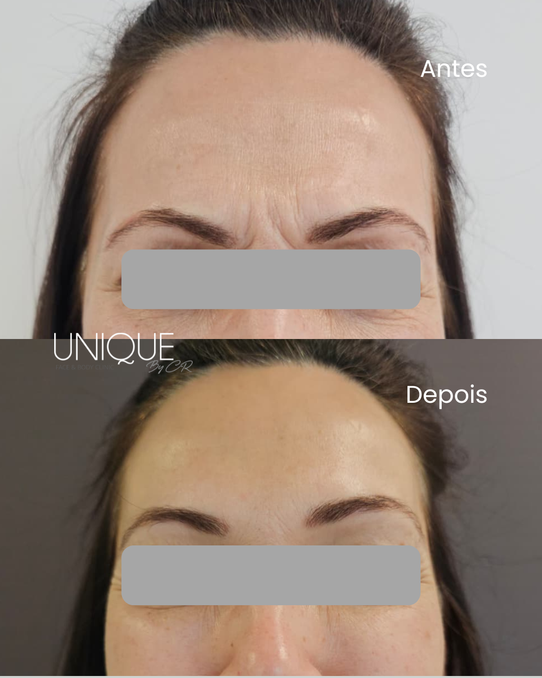 Antes e depois — suavização das linhas de expressão da glabela