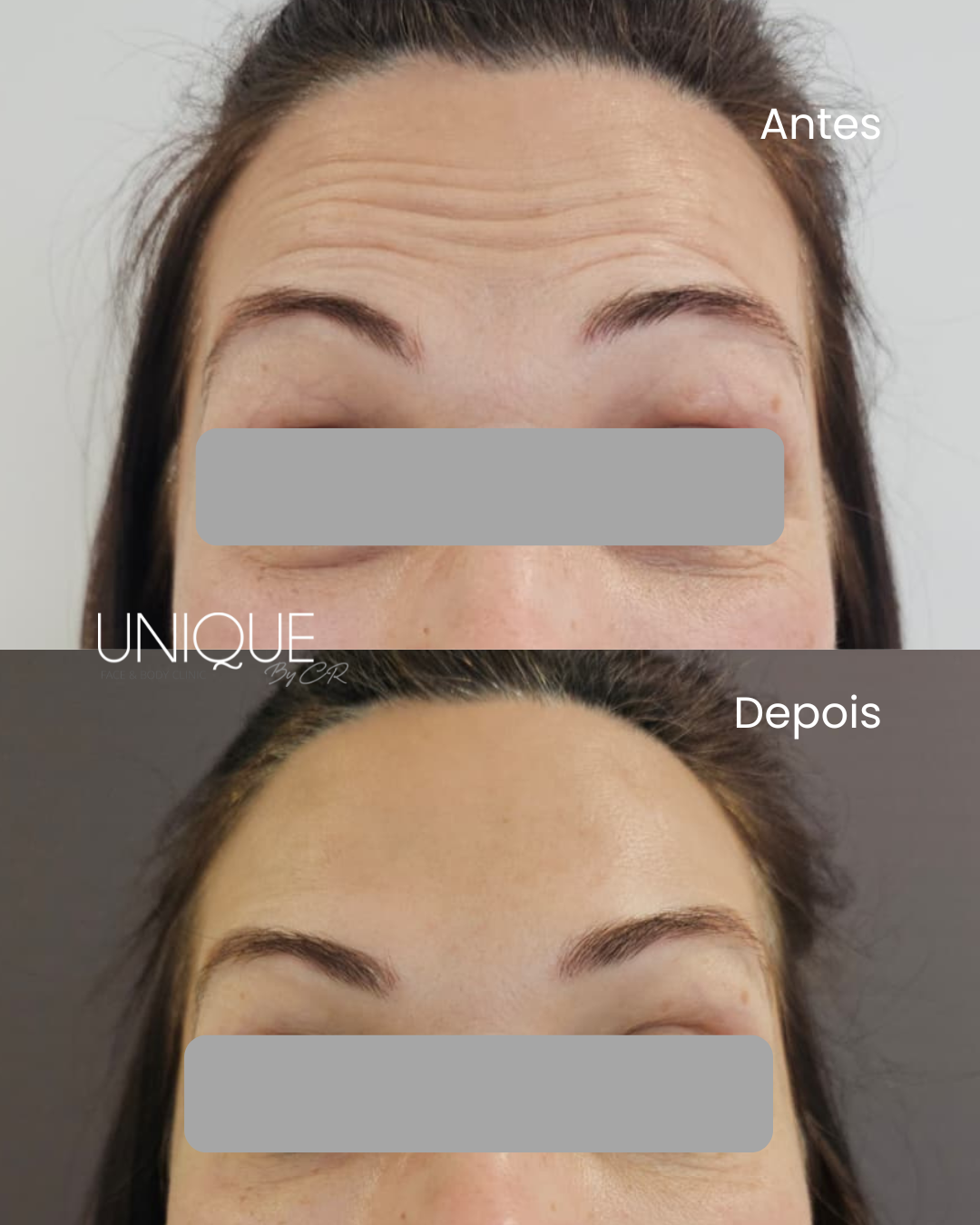 Antes e depois — tratamento de rugas profundas da testa