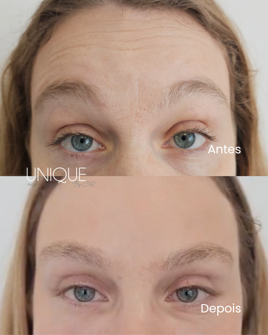 Antes e depois — prevenção de rugas finas da testa