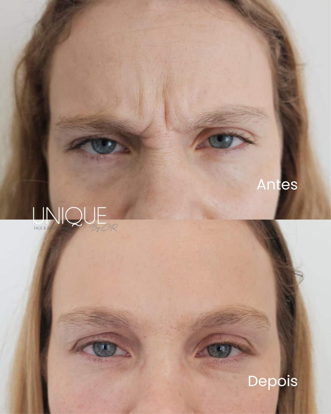 Antes e depois — toxina botulínica na glabela (linhas do “11”)