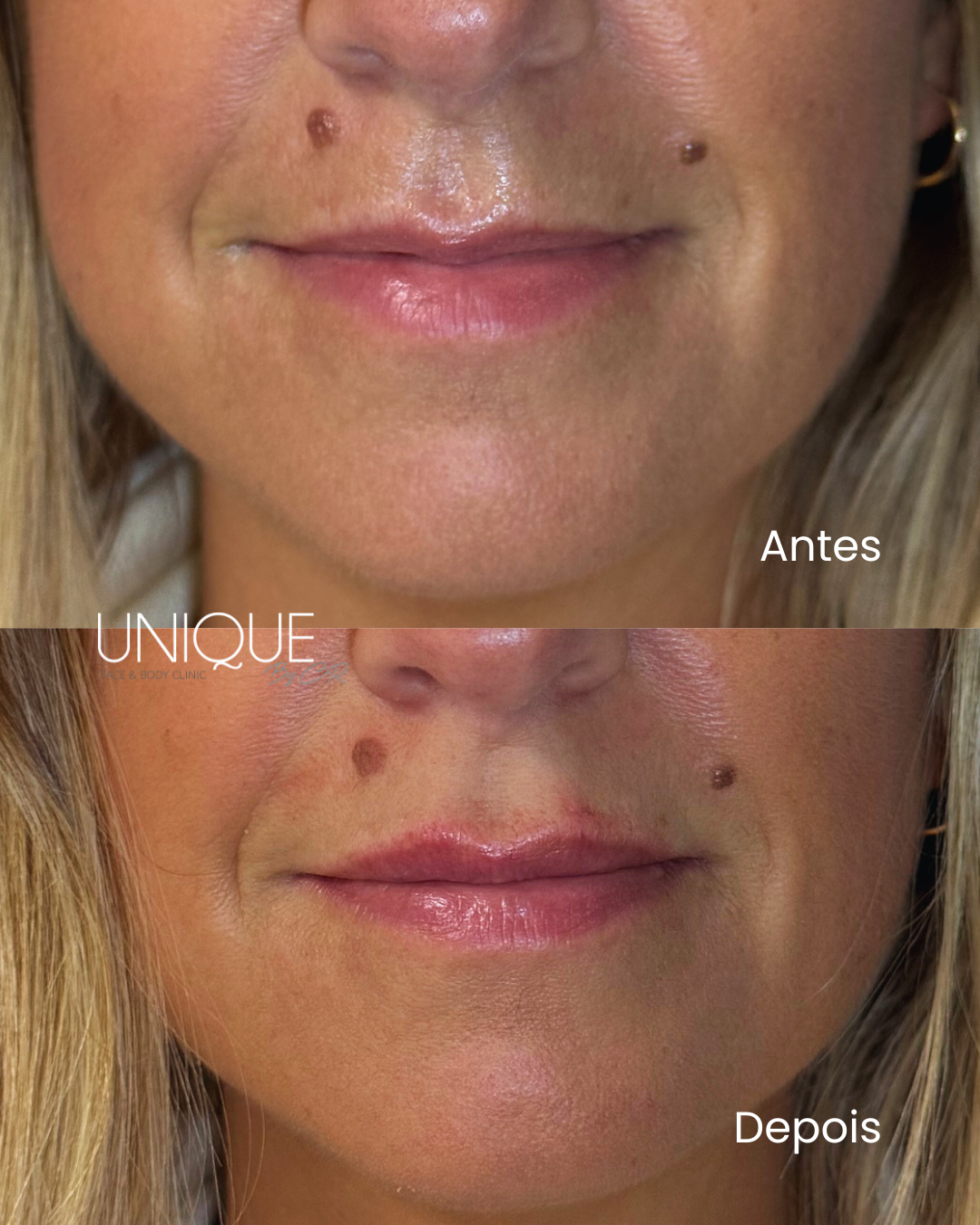 Antes e depois — preenchimento labial com ácido hialurónico