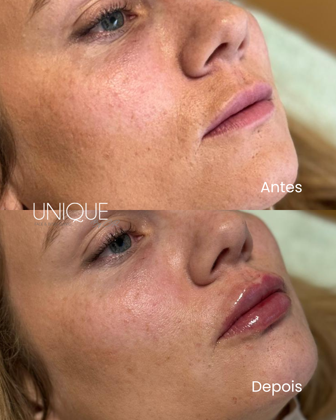 Antes e depois — hidratação e volume labial com ácido hialurónico